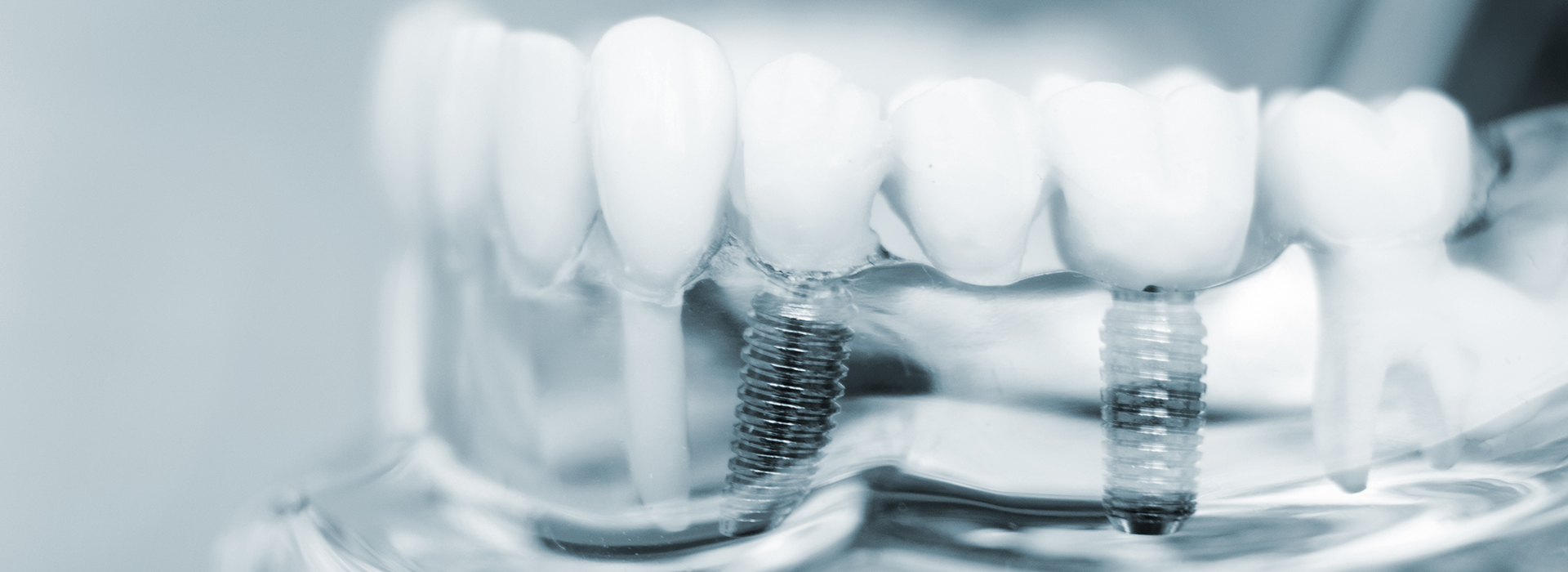 This image shows a close-up of multiple teeth with visible braces, set against a blurred background that appears to be a transparent overlay.