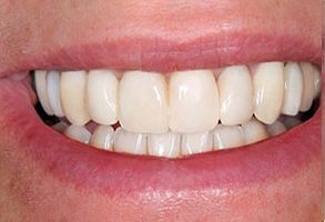 The image shows a close-up of a person s mouth with a radiant smile, displaying white teeth and gums.