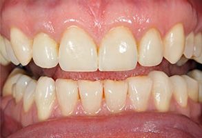An image of a person s teeth with a focus on the lower front teeth, showcasing a yellowish-brown discoloration.