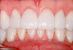 The image shows a close-up of a person s teeth with a focus on the bottom row, which includes a dental implant and natural teeth.