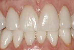 The image displays a close-up of a person s teeth, showing a set of white teeth with some yellowing and staining, particularly around the gumline.
