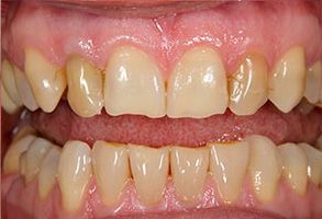 The image shows a close-up of a person s teeth with yellowing, indicating the need for dental care or cosmetic procedures.